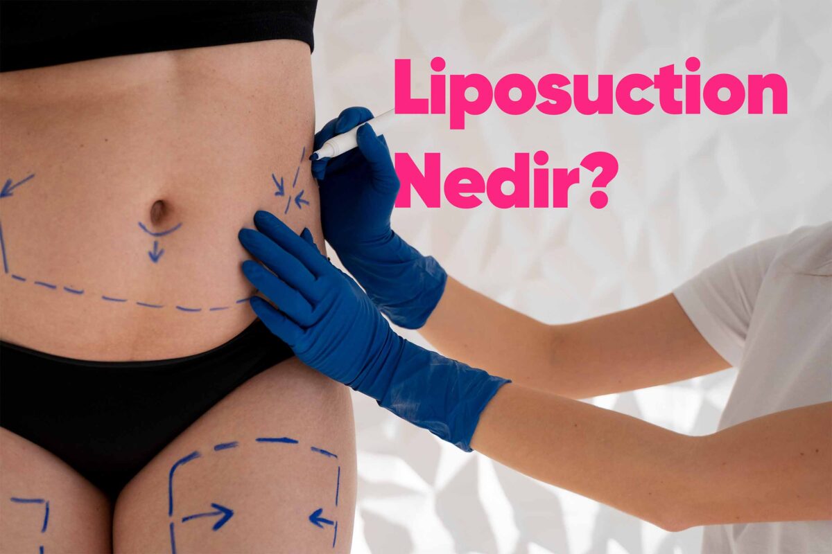 liposuction-nedir
